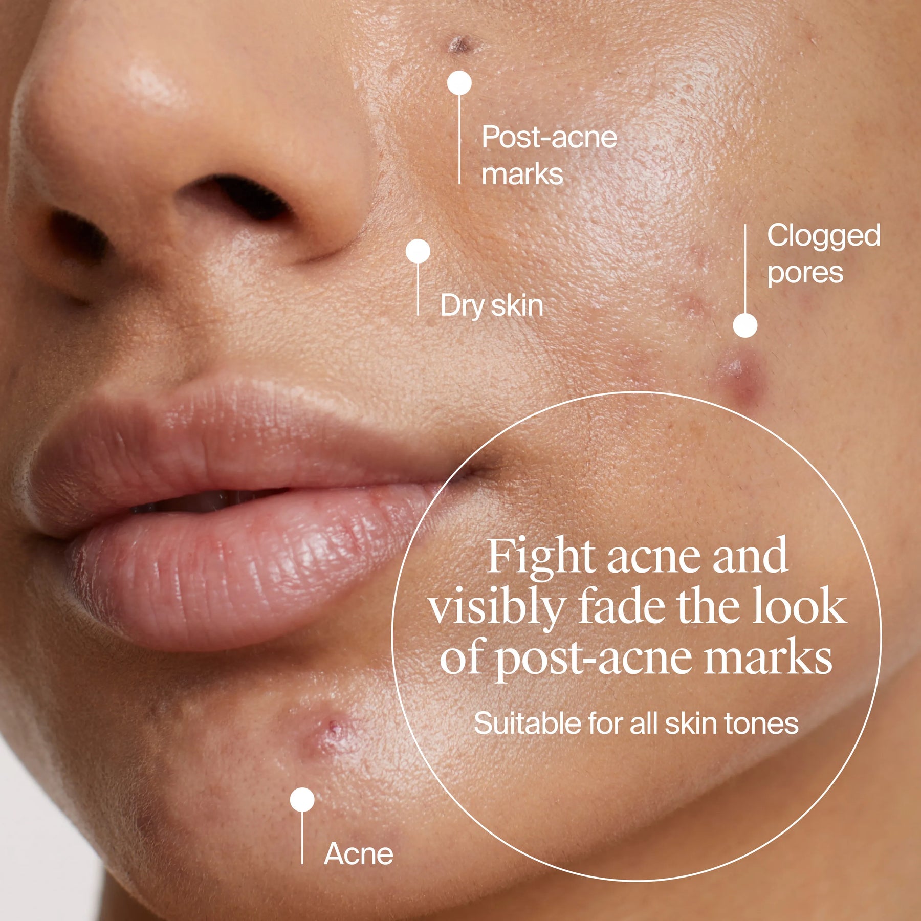 Neutrogena® Acne-Fighting Skincare Solutions Regimen Duo