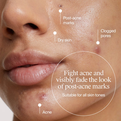 Neutrogena® Acne-Fighting Skincare Solutions Regimen Duo