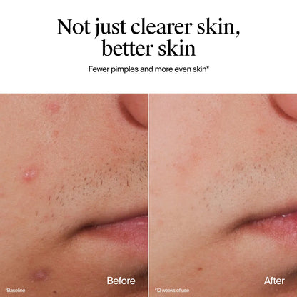 Neutrogena® Oil-Free Acne Wash, Fragrance Free 9.1 FL. Oz