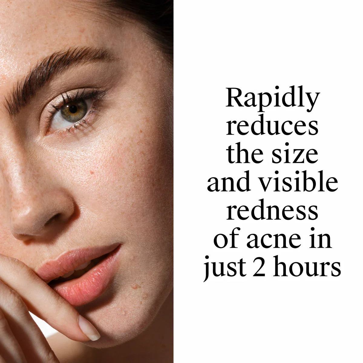 Neutrogena® Rapid Clear Stubborn Acne Spot Gel, 1 Oz