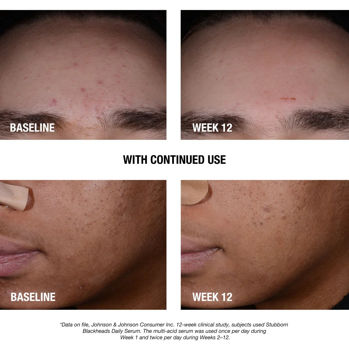 Neutrogena® Stubborn Blackheads Daily Acne Facial Serum, 1 Fl. Oz